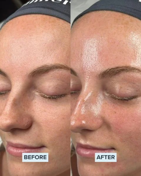Chemical Peel Before and after 5