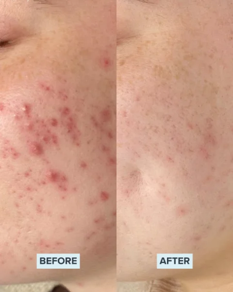 Chemical Peel before and after 1