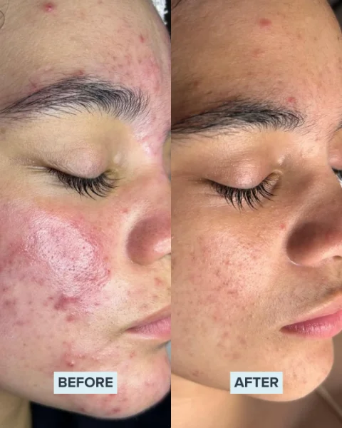 Chemical Peel before and after 2