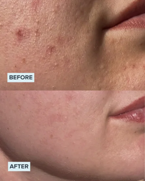 Chemical Peel before and after 3