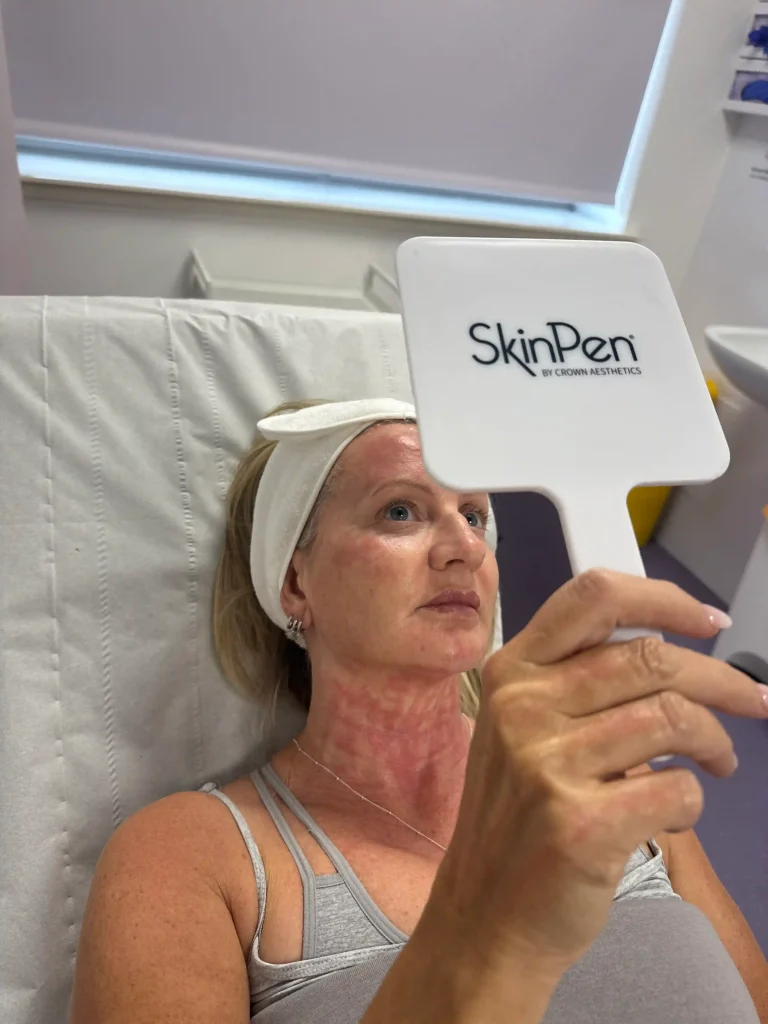 Patient checking results in mirror immediately after SkinPen microneedling treatment at MediGlow Glasgow - visible redness is a normal response and typically resolves within 24 hours