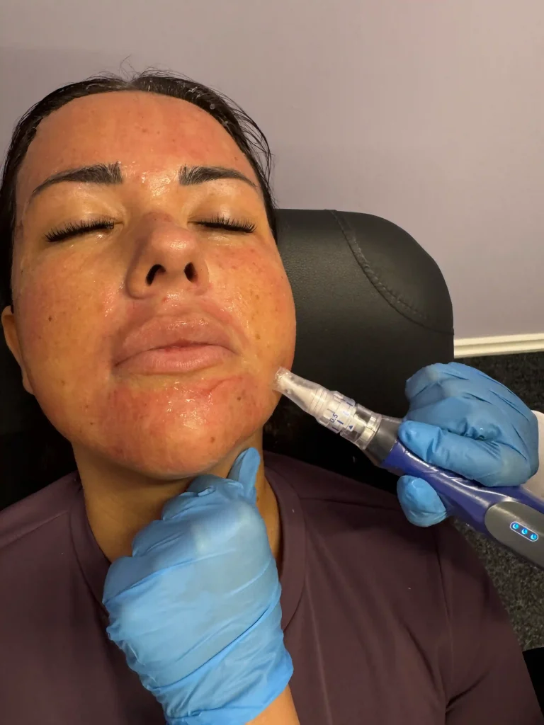 SkinPen microneedling treatment in progress at MediGlow Aesthetics Glasgow - normal post-treatment redness on face, administered by pharmacist independent prescriber