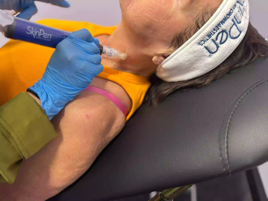 SkinPen Precision FDA-cleared microneedling device being used with PDRN serum on patient's neck at MediGlow Aesthetics & Health, Thornliebank, Glasgow