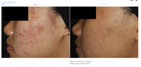 Laser Genesis improvement in acne-related redness. Photo courtesy of Cutera, Inc