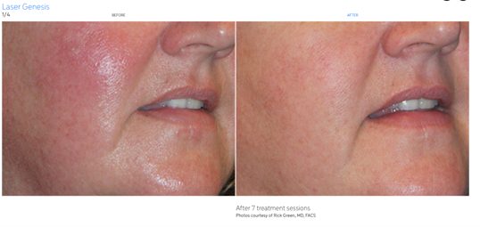Laser Genesis improvement in facial redness and skin texture. Photo courtesy of Cutera, Inc.