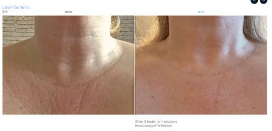 Laser Genesis improvement in neck skin quality. Photo courtesy of Cutera, Inc.